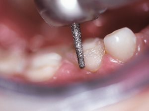 6856_Diamond_Bur.jpg