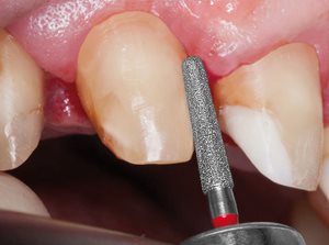 8856_Diamond_Bur_In_Use_Image 1.jpg