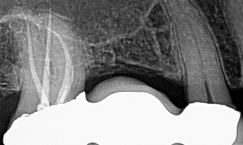 Endodontic Case Study: Increase Patient Safety and Clinical Efficiency with Komet Instruments