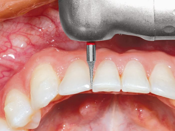Orthodontic Interproximal Reduction (IPR) Burs and Instruments